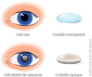 Chirurgie de la cataracte Centre ophtalmologique
